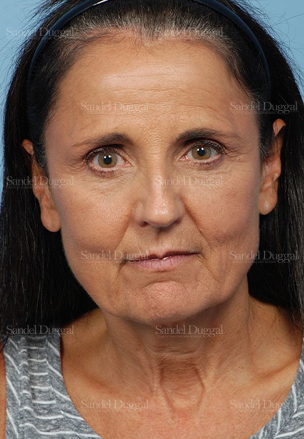 Facelift before, case 2661