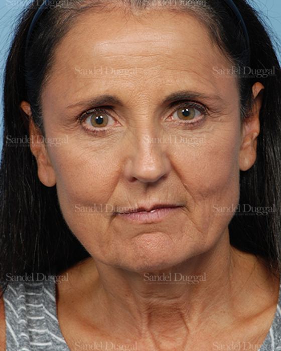 Facelift before, case 2661