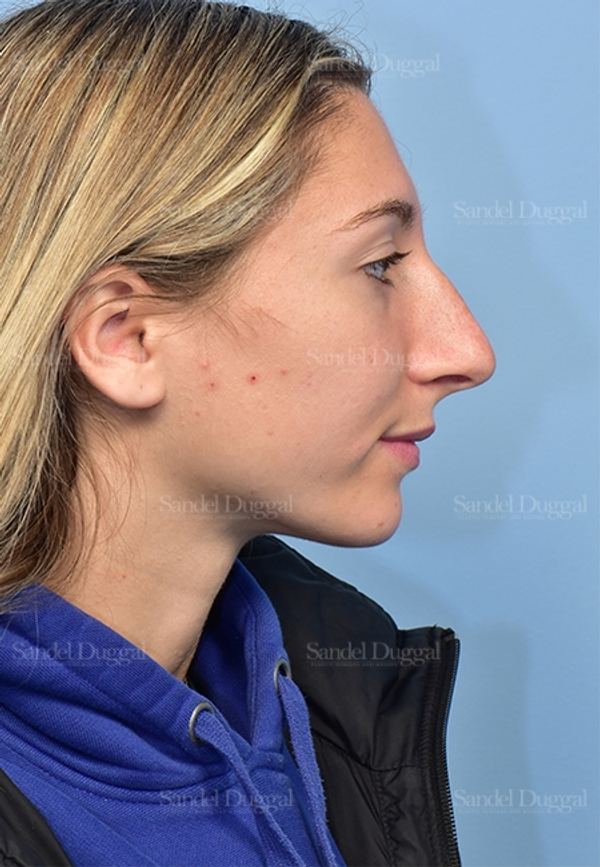 Rhinoplasty before, case 5375