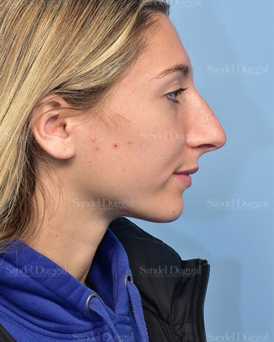 Rhinoplasty before, case 5375