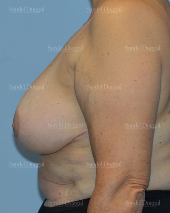 Breast Lift after, case 3287