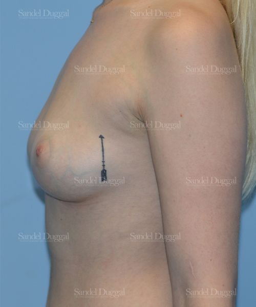 Breast Augmentation before, case 3129