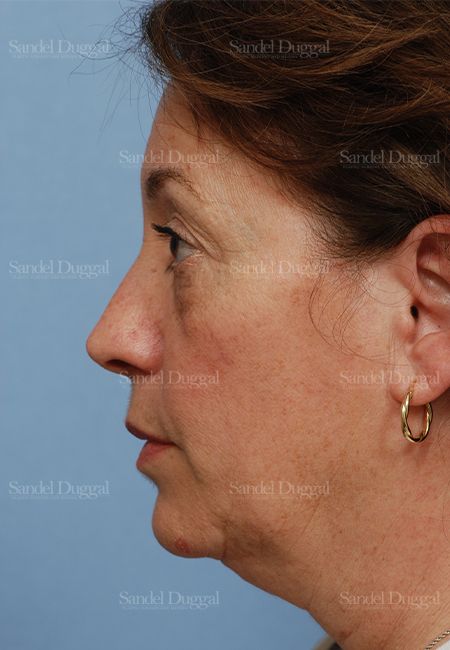 Facelift before, case 813
