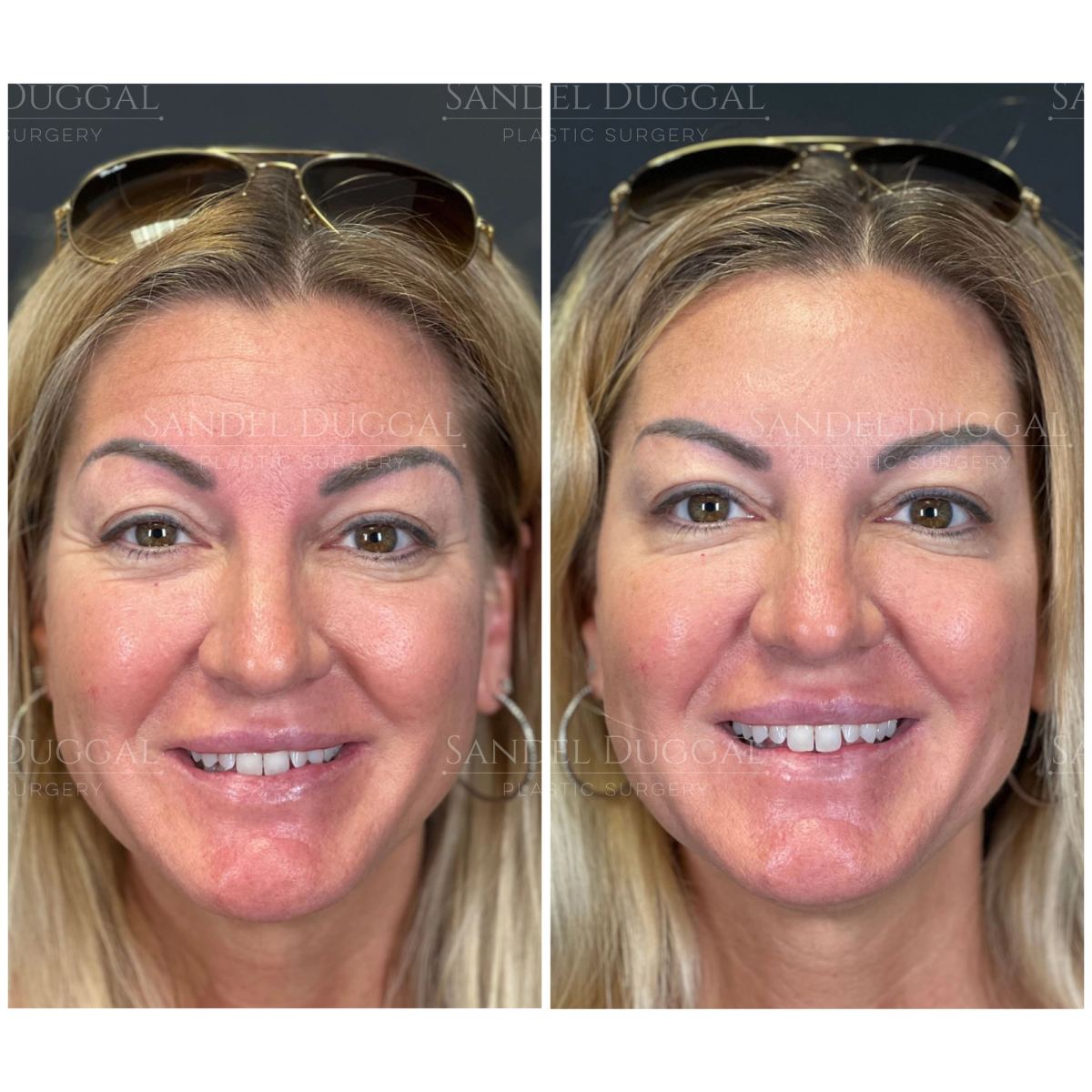Botox & Fillers before and after, case 6010