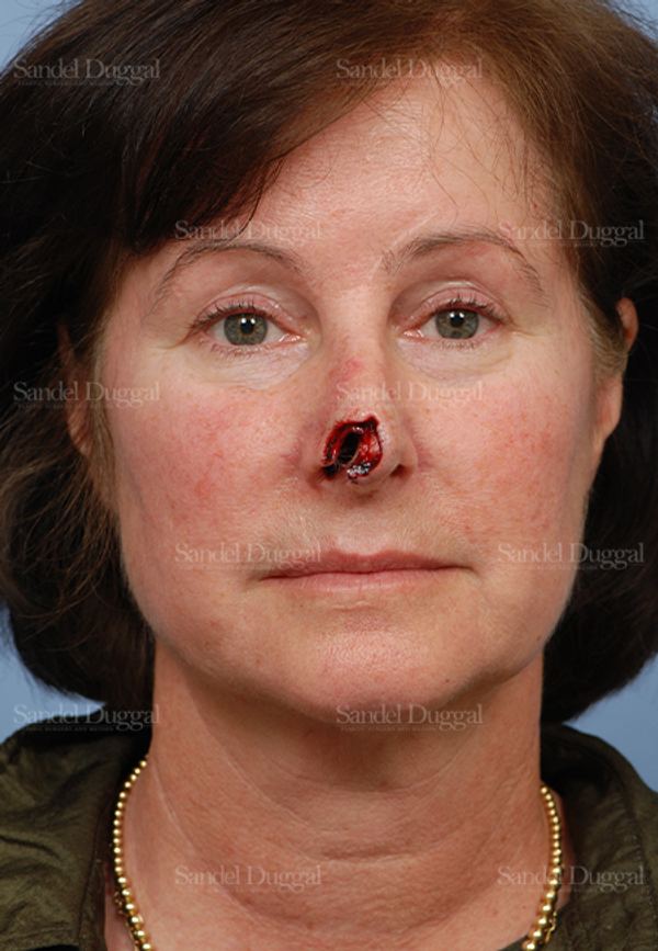 Reconstruction after Mohs before, case 2781