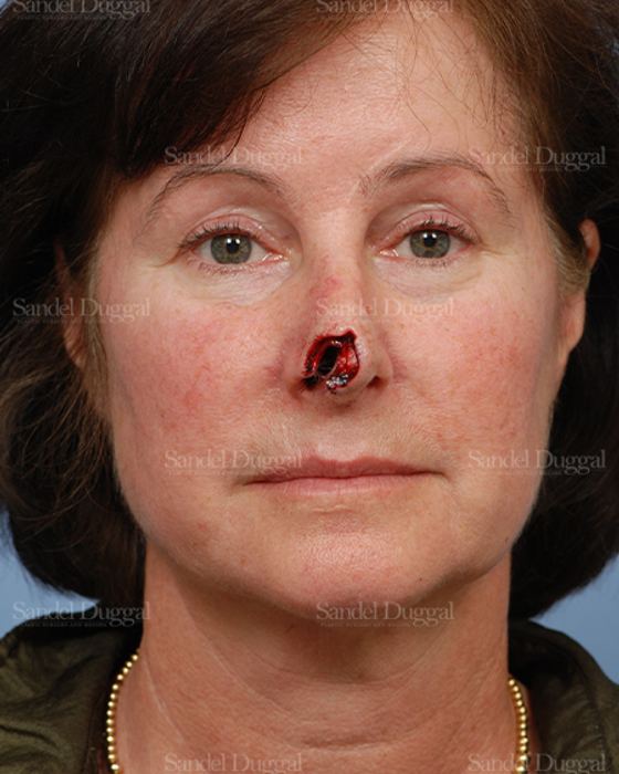 Reconstruction after Mohs before, case 2781
