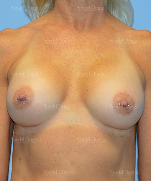 Breast Augmentation after, case 3248