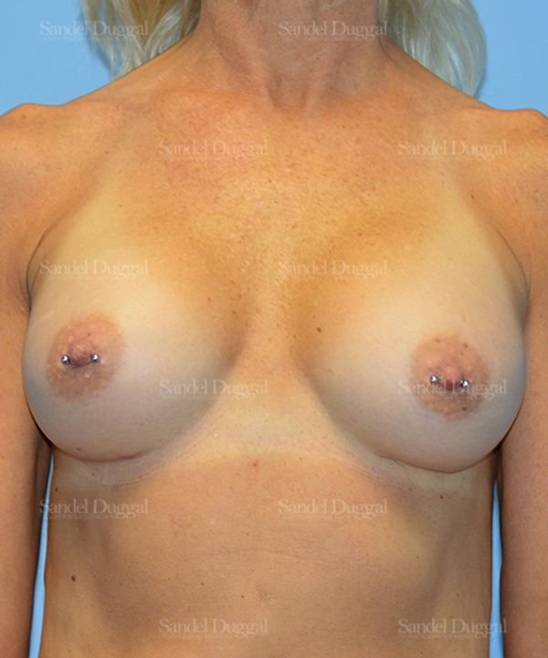 Breast Augmentation after, case 3248