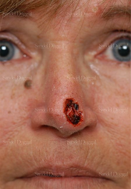 Reconstruction after Mohs before, case 2796