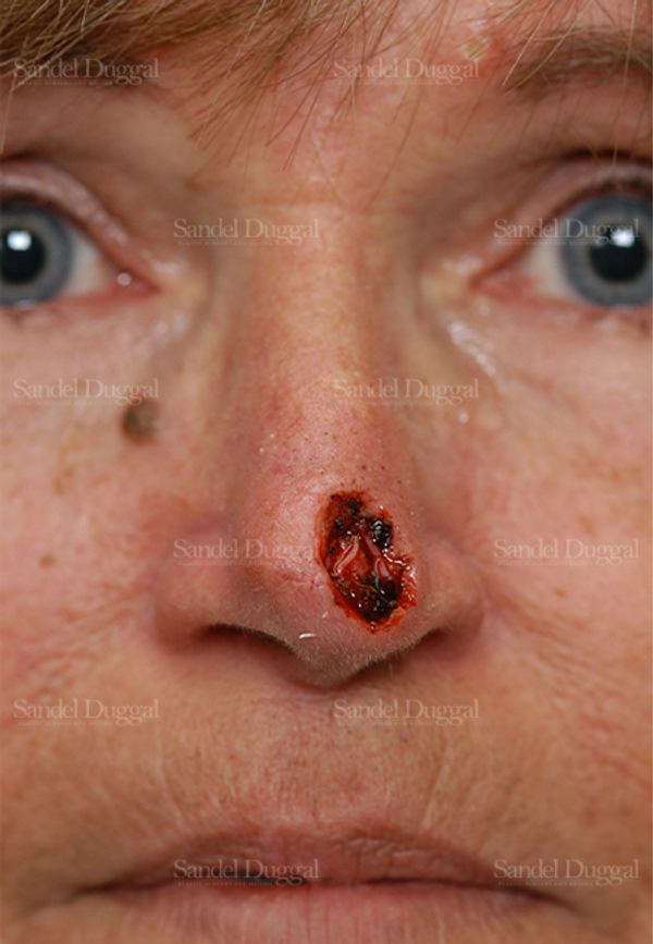 Reconstruction after Mohs before, case 2796