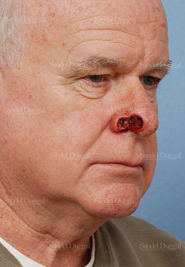 Reconstruction after Mohs before, case 2802