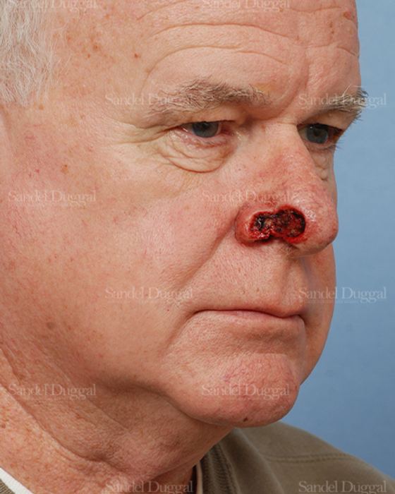 Reconstruction after Mohs before, case 2802