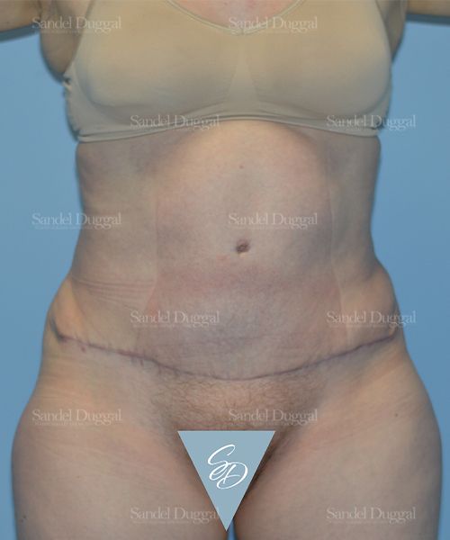 Tummy Tuck after, case 1666