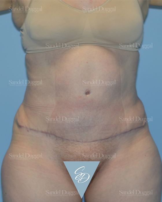 Tummy Tuck after, case 1666