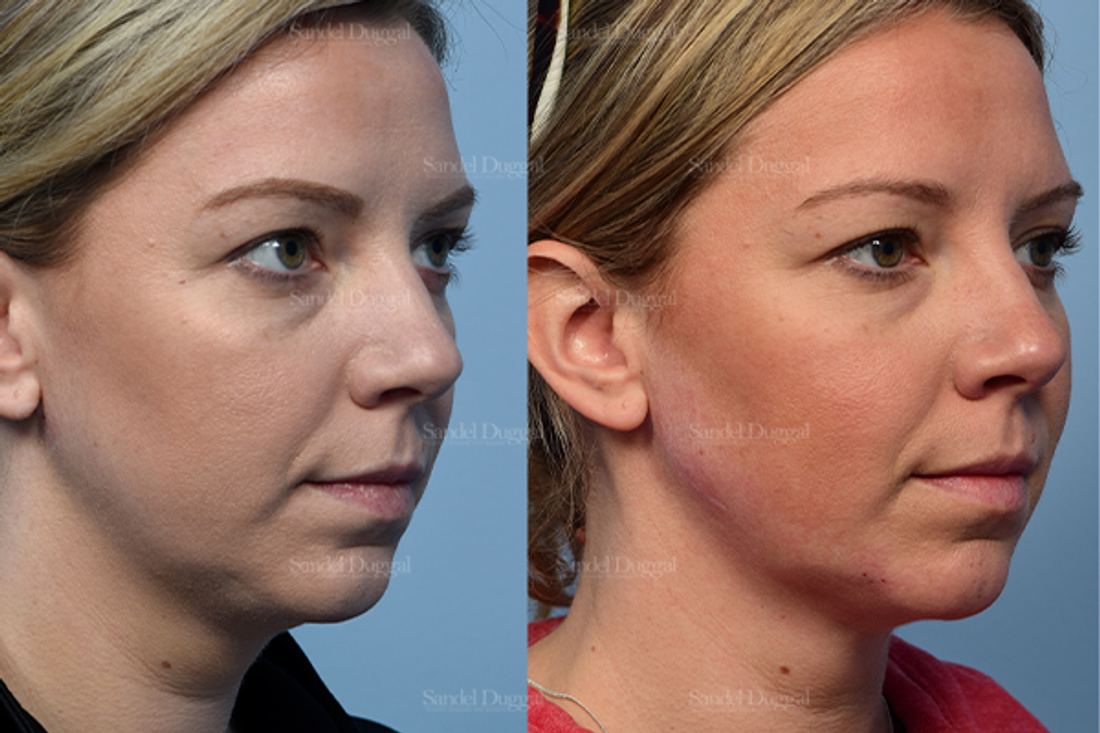 Neck & Chin Liposuction before and after, case 2550