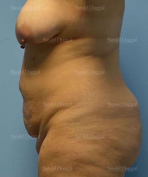 Tummy Tuck before, case 1701