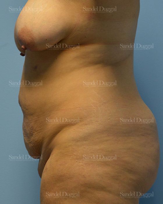 Tummy Tuck before, case 1701
