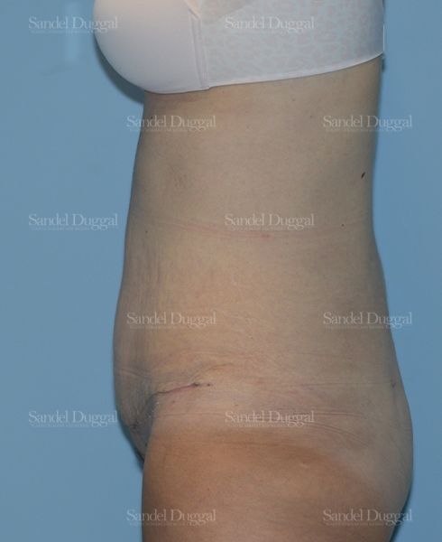 Tummy Tuck after, case 1722