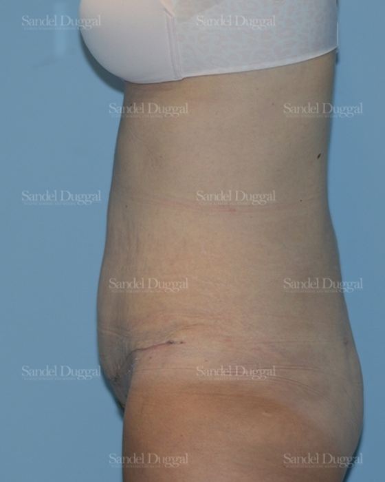 Tummy Tuck after, case 1722