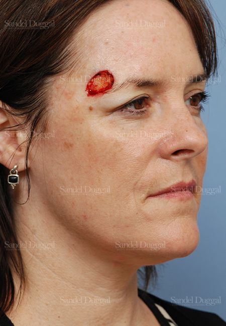 Reconstruction after Mohs before, case 2760