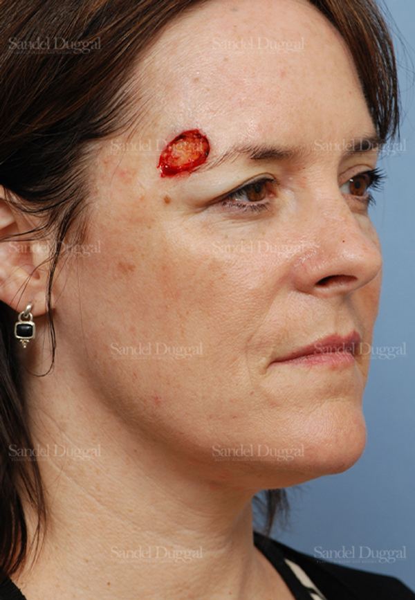 Reconstruction after Mohs before, case 2760