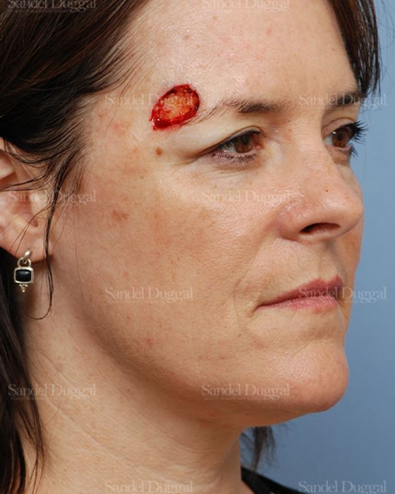 Reconstruction after Mohs before, case 2760