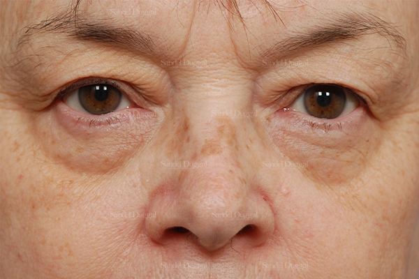 Eyelid Rejuvenation before, case 1976