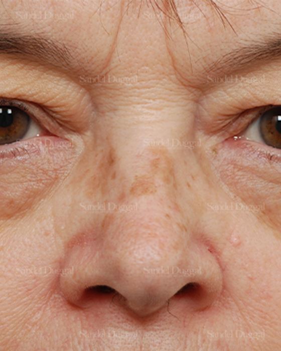 Eyelid Rejuvenation before, case 1976