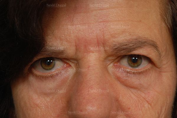 Eyelid Rejuvenation before, case 1943