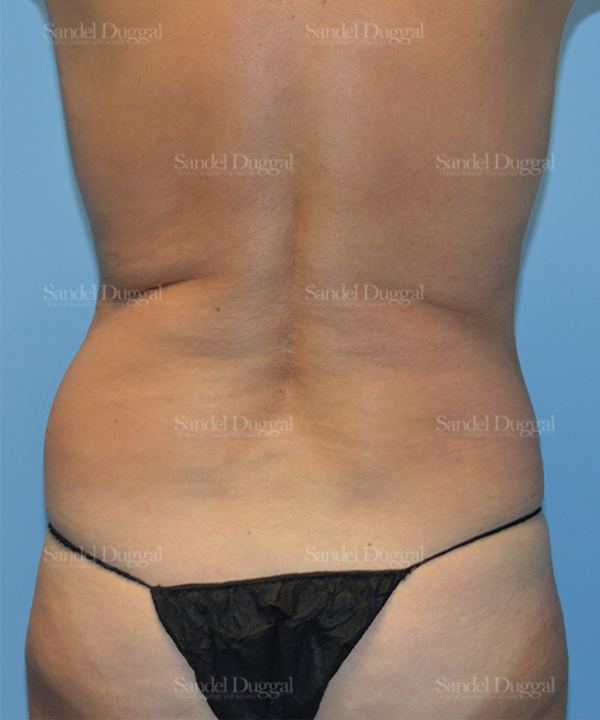 Liposuction — Legs & Flanks before, case 2501