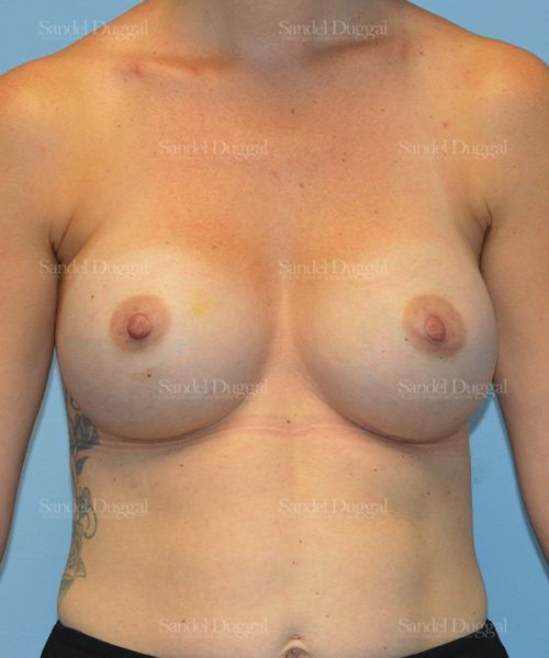 Breast Augmentation after, case 3178