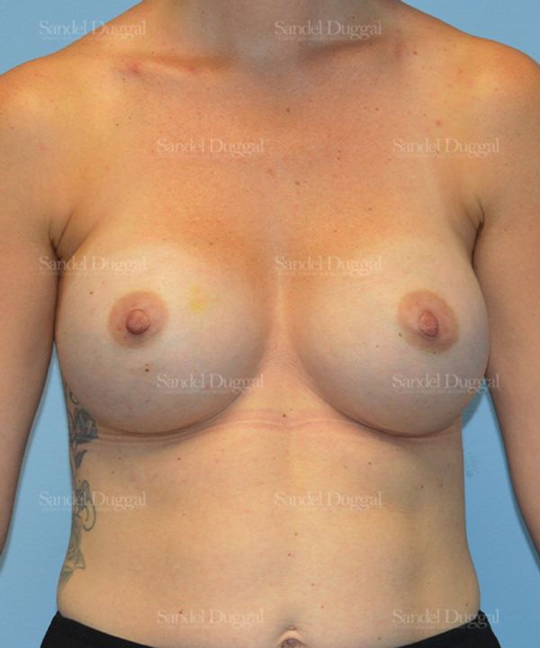 Breast Augmentation after, case 3178
