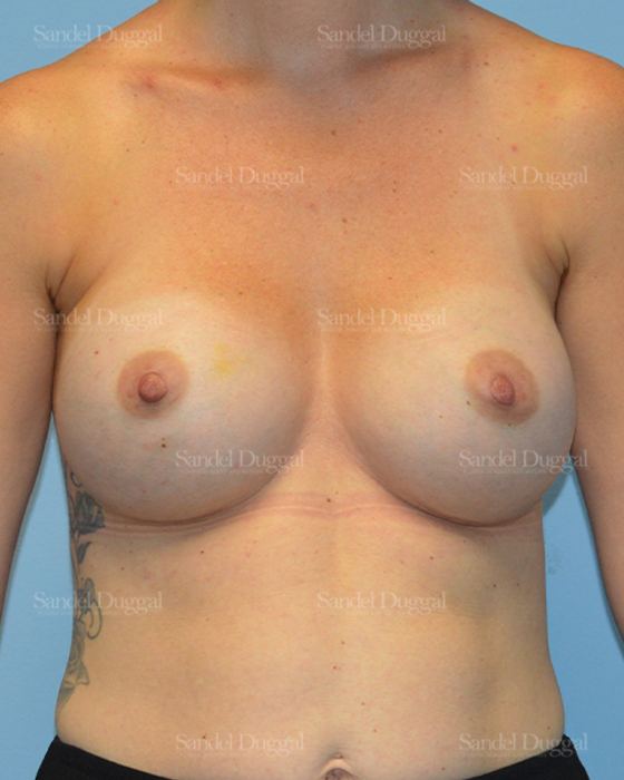 Breast Augmentation after, case 3178