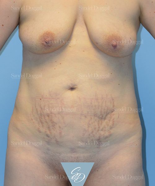 Tummy Tuck before, case 1659