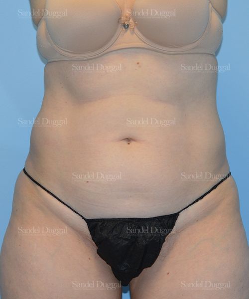 Liposuction — Abdomen before, case 2469