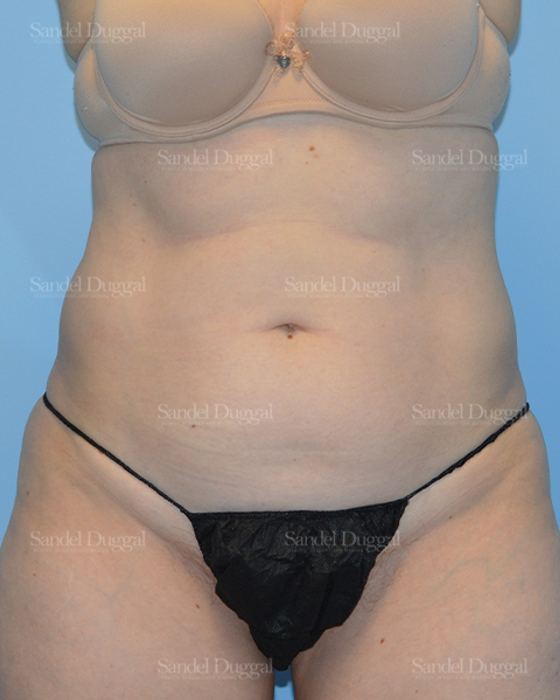Liposuction — Abdomen before, case 2469