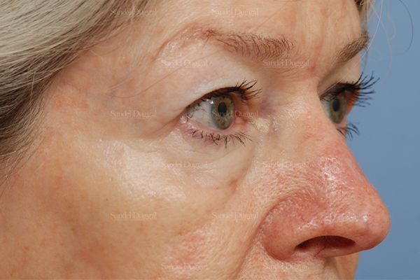 Eyelid Rejuvenation before, case 1912