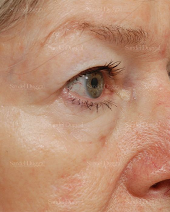 Eyelid Rejuvenation before, case 1912