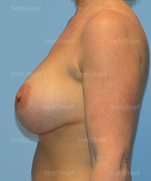 Breast Augmentation after, case 3220