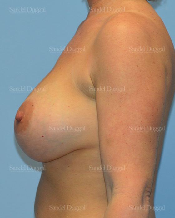 Breast Augmentation after, case 3220