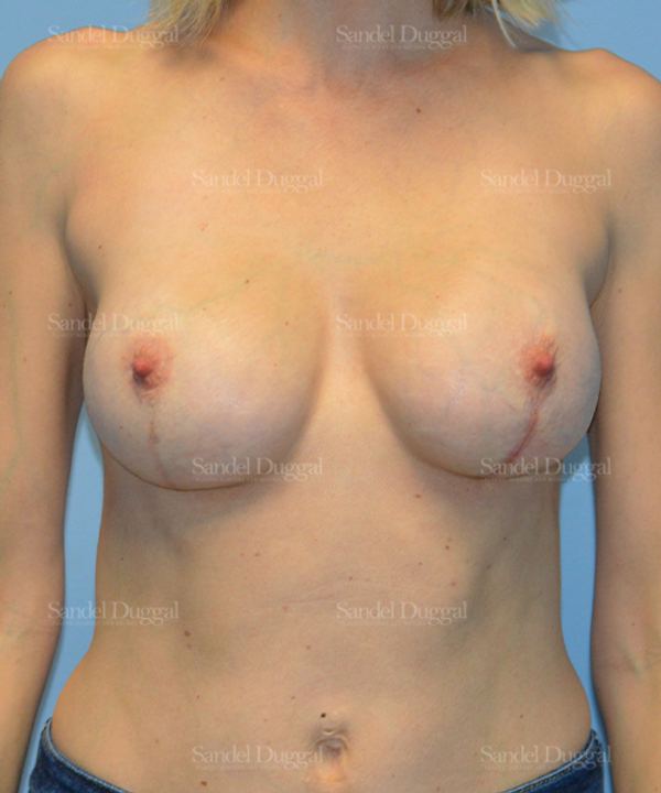 Breast Augmentation with Lift after, case 3358