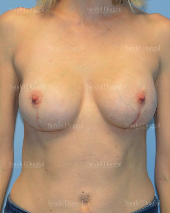 Breast Augmentation with Lift after, case 3358