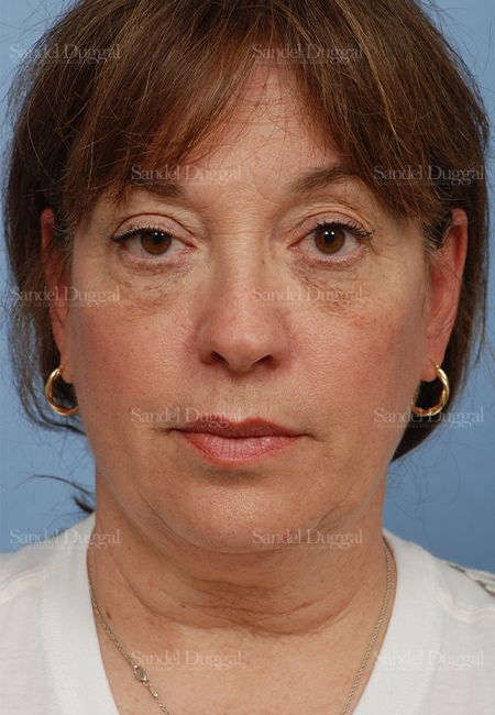 Facelift before, case 813