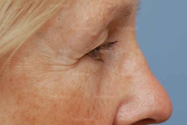 Eyelid Rejuvenation before, case 1940