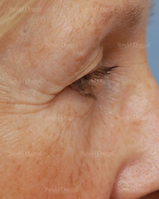 Eyelid Rejuvenation before, case 1940