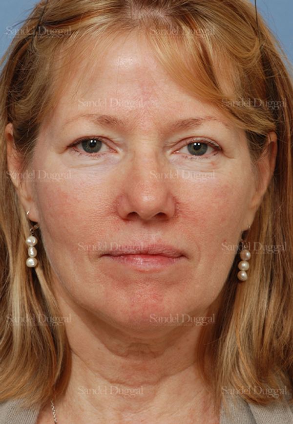 Reconstruction after Mohs after, case 2766
