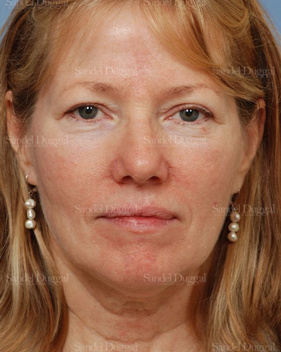 Reconstruction after Mohs after, case 2766