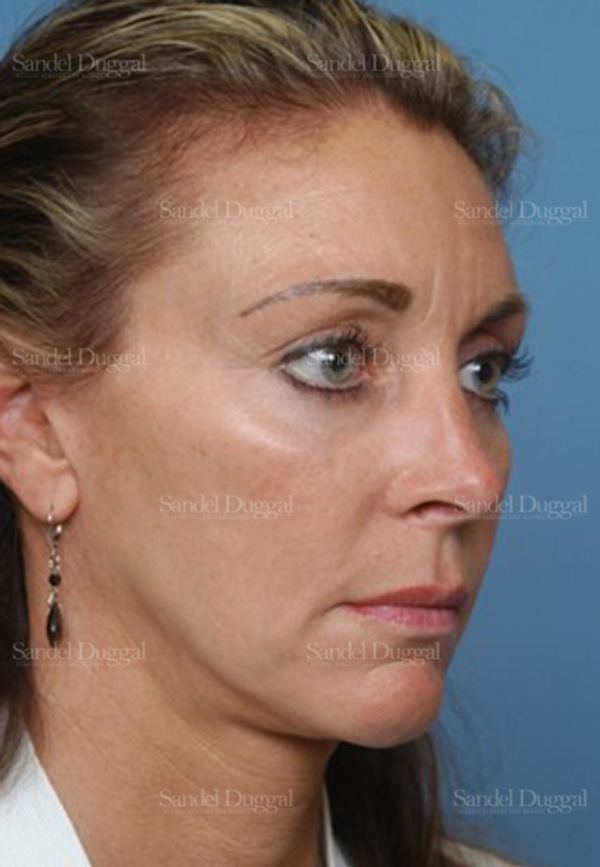 Rhinoplasty after, case 2906