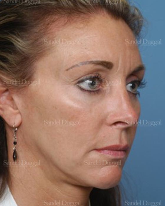 Rhinoplasty after, case 2906