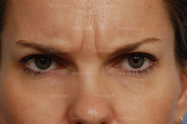 Botox & Fillers before, case 842